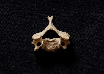 Medición por métodos de imagen del grado de aplastamiento vertebral