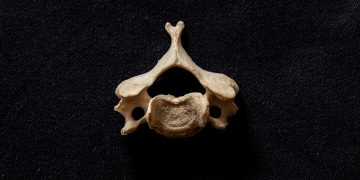Medición por métodos de imagen del grado de aplastamiento vertebral