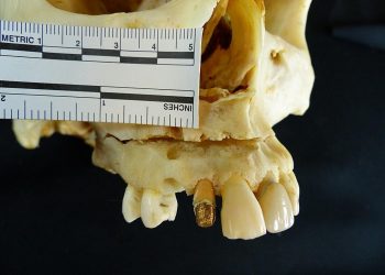 Lesión facial y valor identificativo en un diente