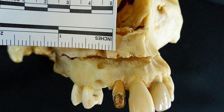 Lesión facial y valor identificativo en un diente