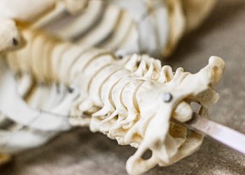 Bucles vasculares en segmento V2 de la arteria vertebral como hallazgo no tan infrecuente