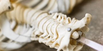 Bucles vasculares en segmento V2 de la arteria vertebral como hallazgo no tan infrecuente
